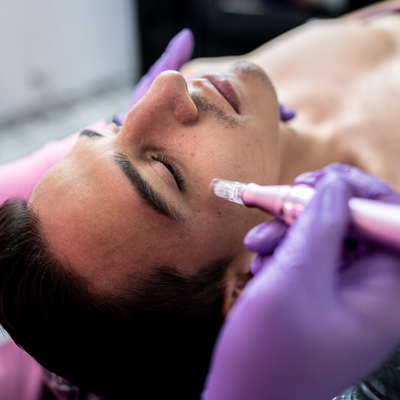 Microneedling in the Periorbital Region: Techniques for Precision and Comfort