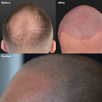 ALOPECIA: SYMPTOMS, CAUSES AND CORRECTION